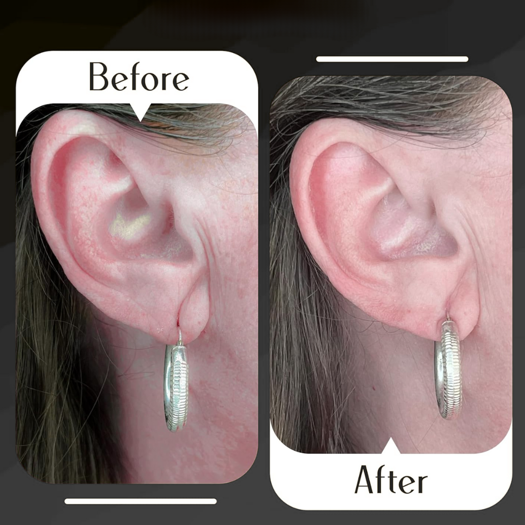 Premium Earlobe Support Patches | BUY 50 GET 50 FREE